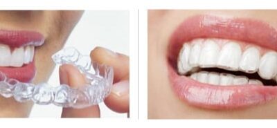 Does Invisalign Work?