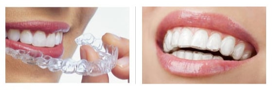 girl wearing invisalign in NW Calgary