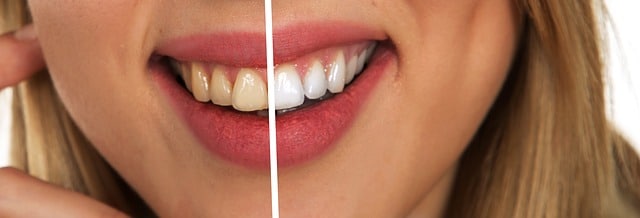 Before after image of teeth whitening in NW Calgary