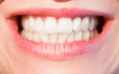 Want Veneers? Here’s What You Should Consider