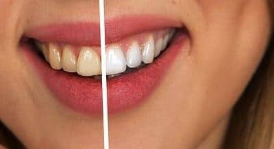 How Teeth Whitening Works