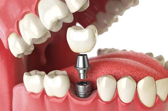 Illustrative image of dental implants in NW Calgary