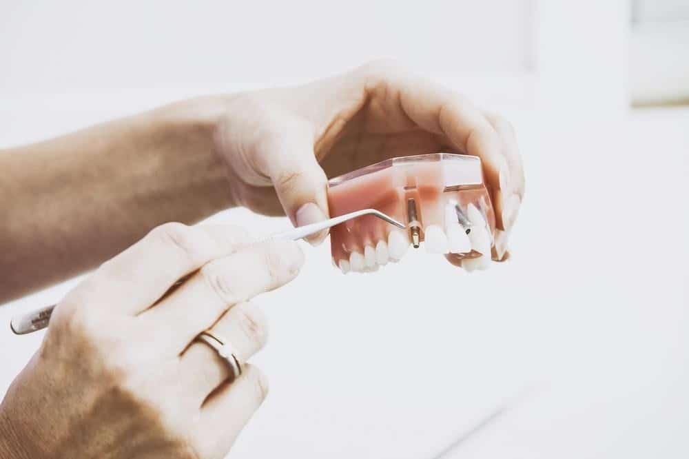 Dental model illustrating gum desease