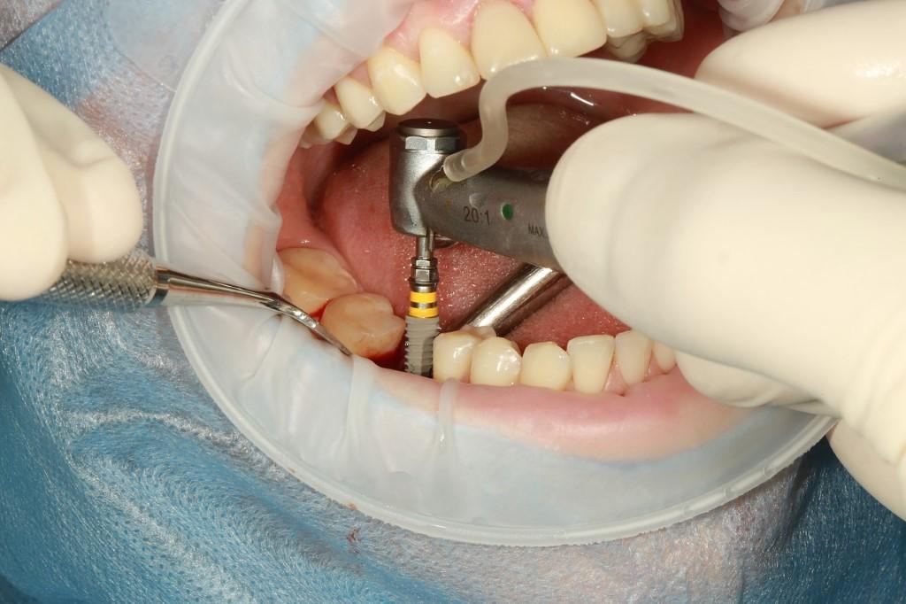 Dentist performing dental implants surgery in NW Calgary
